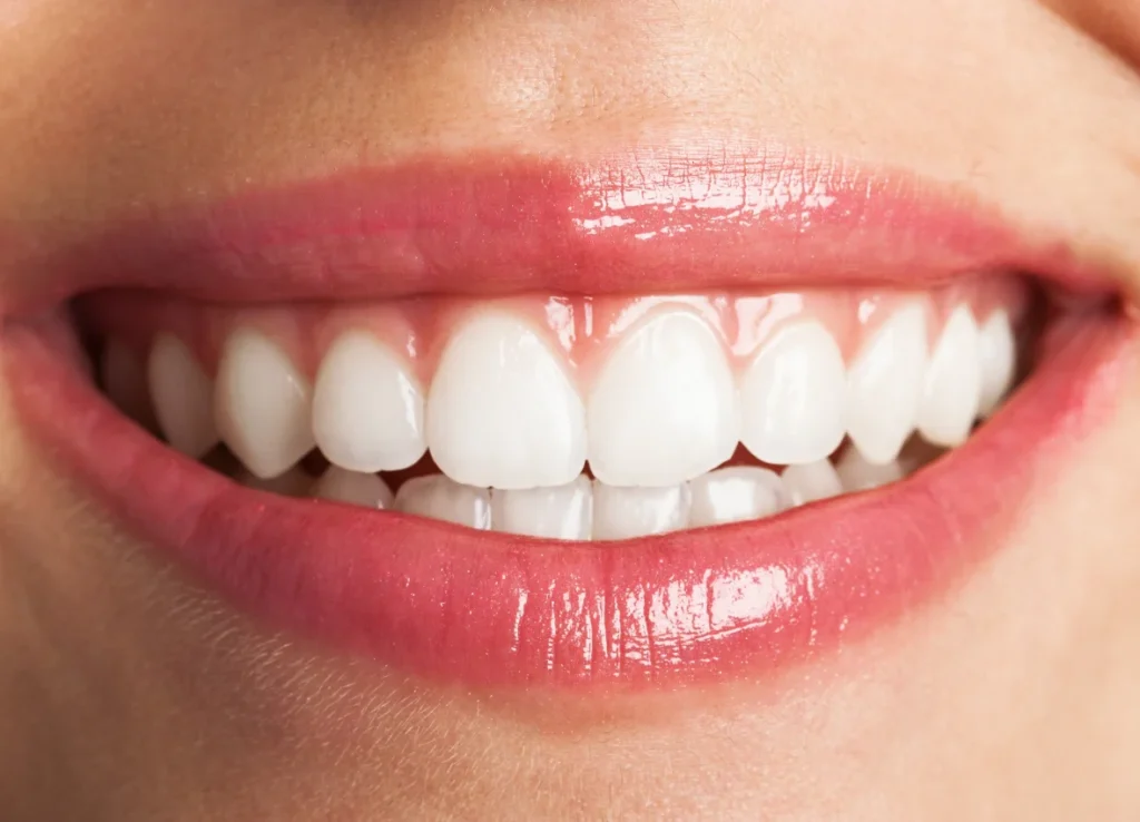 Sonrisa natural tras un tratamiento de estética dental en Sotogrande