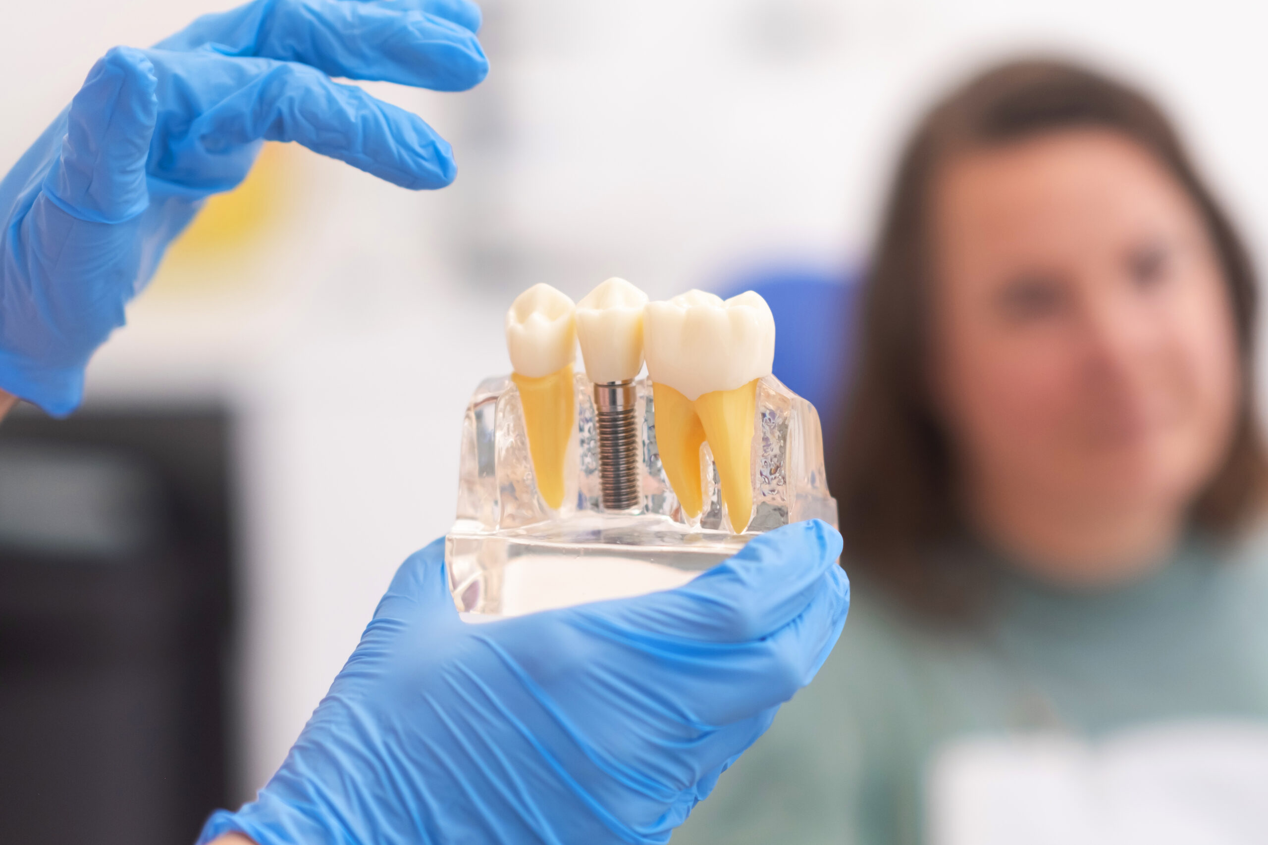 Primer plano de modelo dental con implante. Paciente de clínica dental sobre fondo difuminado. Conceptos de odontología.